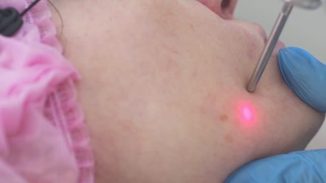 Удаление сосудистых звездочек неодимовым лазером Fotona смотреть онлайн