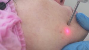 Удаление сосудистых звездочек неодимовым лазером Fotona