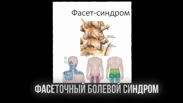 СПОНДИЛОЛИСТЕЗ. Что такое НАСТОЯЩЕЕ смещение позвонка? Что с этим делать?