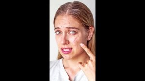 Акне на лице. Причины развития и методы лечения