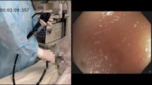 Колоноскопия после резекции толстой кишки