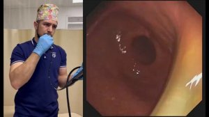 Трансназальная гастроскопия ультратонким гастроскопом.