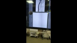 Пункция бедренной артерии. Angioseal