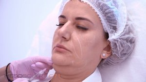 Mesosculpt + Ulthera - Лучшее сочетание процедур или как получить эффект -10 лет после 1 процедуры?