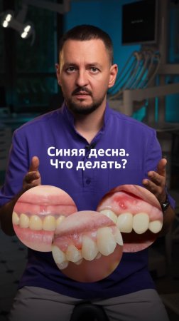 Синяя десна - что делать?

#colibridentalclinic #имплантациязубов #импланты #зубныеимпланты