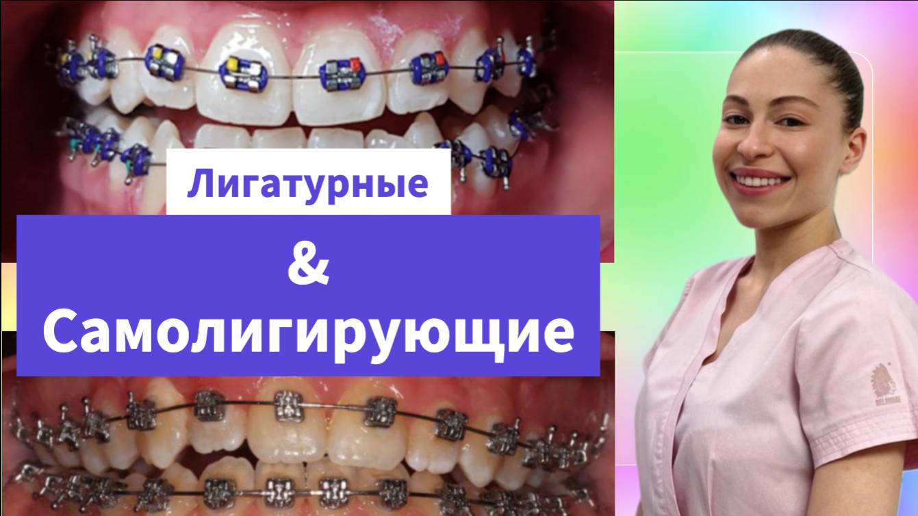 Лигатурные и самолигирующие брекеты - в чем разница