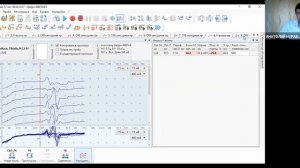 Пример из практики ЭМГ: полиневропатия | Вебинар Нейрософт