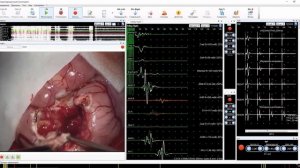 Интраоперационный мониторинг при резекции опухоли головного мозга | Нейро-ИОМ