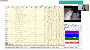 Длительный ЭЭГ-видеомониторинг при диагностике эпилепсии