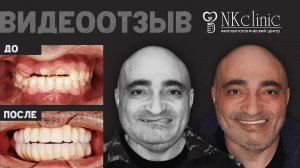 Удалили опухоль и восстановили челюсть за одну операцию. Видеоотзыв пациента