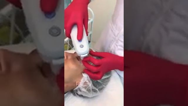 Безоперационная альтернатива хирургической блефаропластике   альтера!