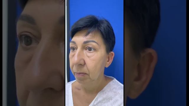 Отзыв Елены о блефаропластике в Институте на Трубной. Хирург - Плотникова М.В. смотреть онлайн