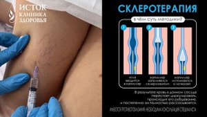 Склеротерапия венозных звездочек в Клинике Здоровья Исток, г. Звенигород