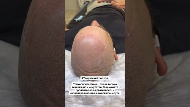 Зажившая трихопигментация