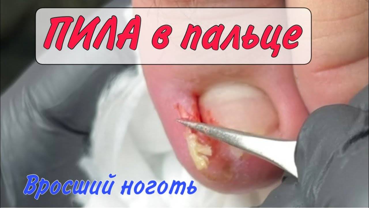 Сложный вросший ноготь _ как убрать вросший ноготь _ врастающий ноготь в кожу _ подолог Москва