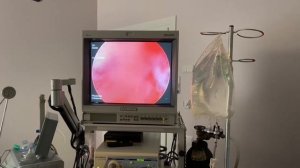 Полное удвоение матки. Гистероскопия.