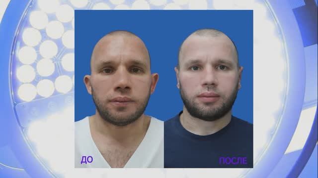 После отопластики: снятие швов и оценка первичного результата.