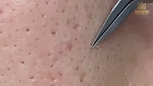 กดสิว blackheads filaments on nose remove with tweezers