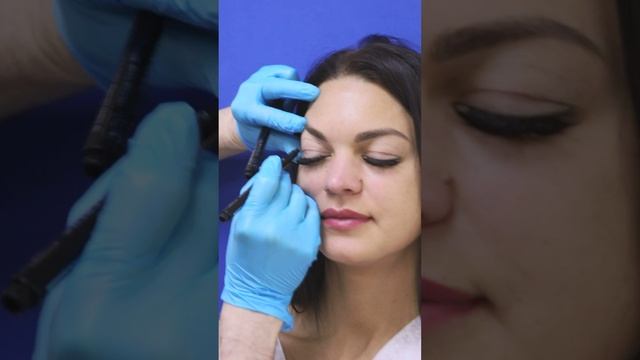 Нанесение разметки перед круговой блефаропластикой. смотреть онлайн