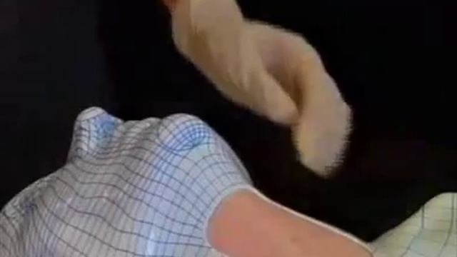 Коникотомия - техника выполнения