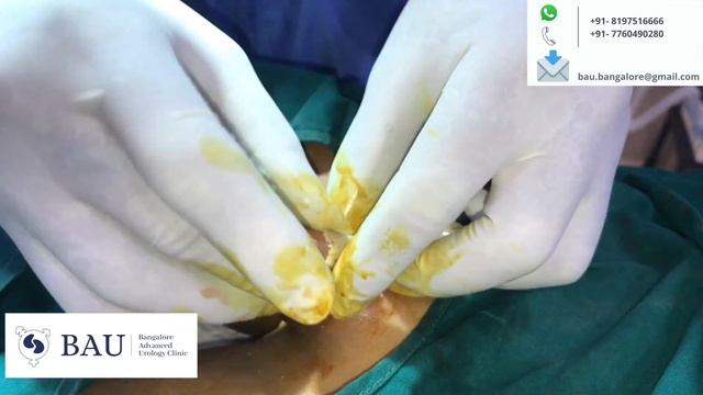 ZSR Circumcision in children / Stitchless Circumcision in Bangalore смотреть онлайн