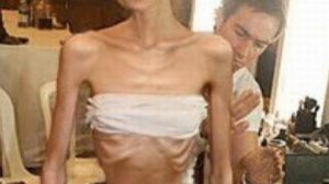 Самые худые люди в мире