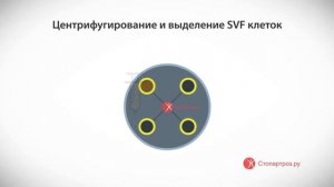 SVF-терапия плечевого сустава