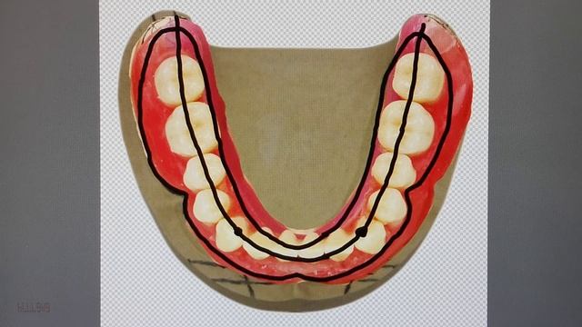 Как грамотно ставятся зубы на съёмный протез