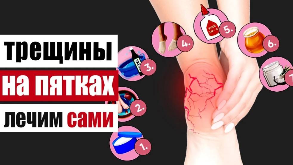 Трещины на пятках – что они скрывают и что делать в домашних условиях