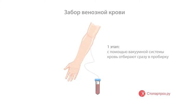 PRP-терапия плечевого сустава