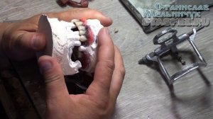 Обратная моделировка зубных коронок. Постановка зубов на съёмных протезах с учетом смещения челюсти.