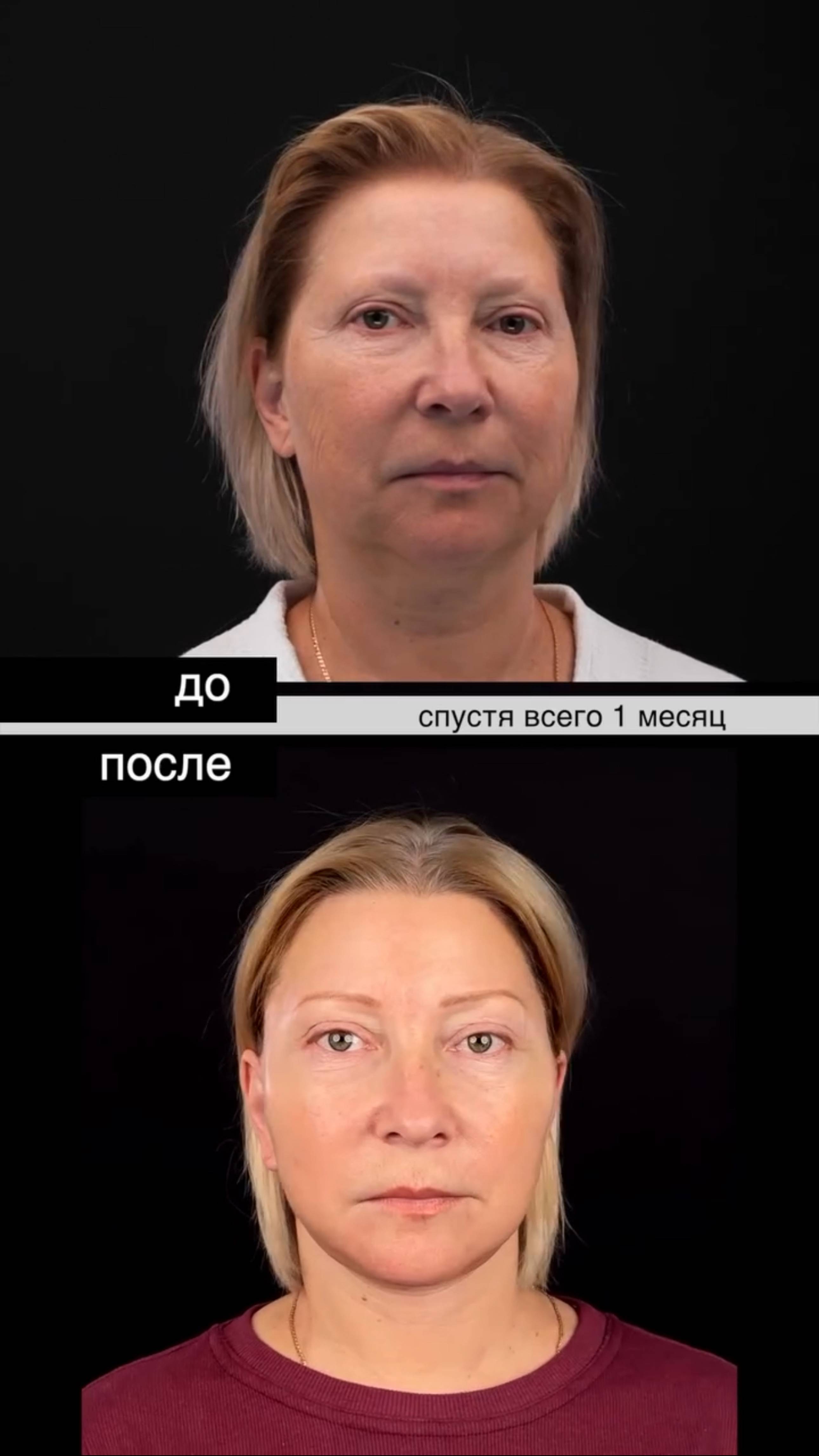 🤩 На сколько помолодела? Пластический хирург ЛИСИН ПАВЕЛ ЭДУАРДОВИЧ #пластикалица #комплекс