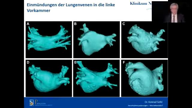 Herzrhythmusstörungen - wie behandeln? смотреть онлайн