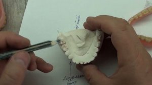 ЗУБНЫЕ ПРОТЕЗЫ. Смещенная вправо нижняя челюсть.