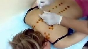 15.РОССИЙСКИЙ метод RANC.33 инъекции за 57 секунд.