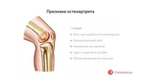 Деформирующий остеоартрит коленного сустава