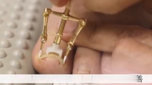 Корректор вросшего ногтя