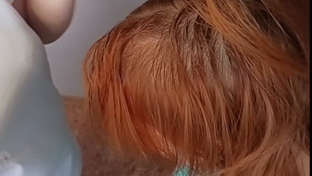 Микронидлинг кожи головы.