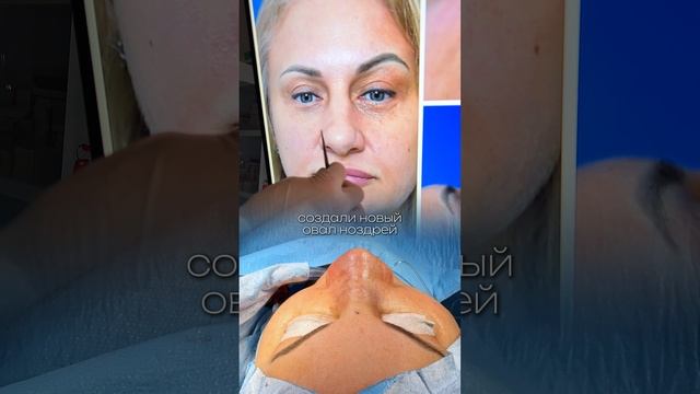 ОПЕРАЦИЯ ПОДОШЛА К КОНЦУ / РИНОСЕПТОПЛАСТИКА АЛИ РАДЖАБОВИЧ / #ринопластика #пластиканоса