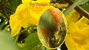 ear wax removal satisfying || ear wax removal biggest || Cleaning ear