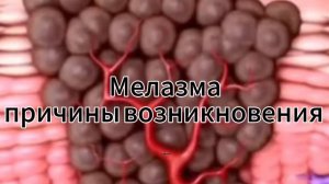 Мелазма. Причины возникновения