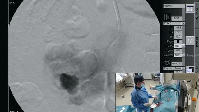 Эмболизация ложной аневризмы