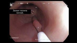 ЭНДОСКОПИЧЕСКАЯ ПОЛИПЭКТОМИЯ ТОЛСТОГО КИШЕЧНИКА.