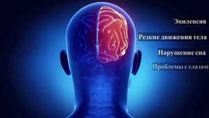 Что такое синдром Ангельмана