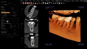 Invivo 6 Endo Workflow