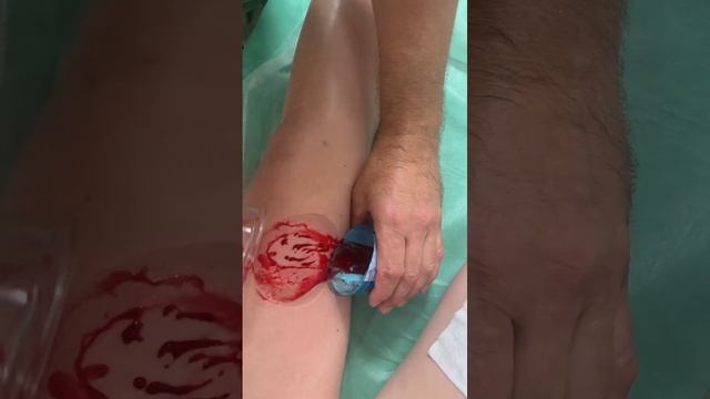 #Кровопускание #банки#медицинскиймассаж #жесть