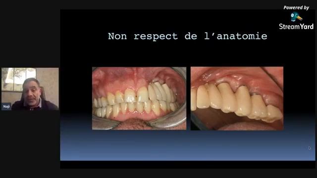 Gestion des échecs des implants dentaires et des greffes osseuses by Dr Naji Abboud (Lebanon) смотреть онлайн
