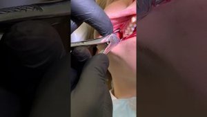 Удаление верхнего ретенированного зуба мудрости