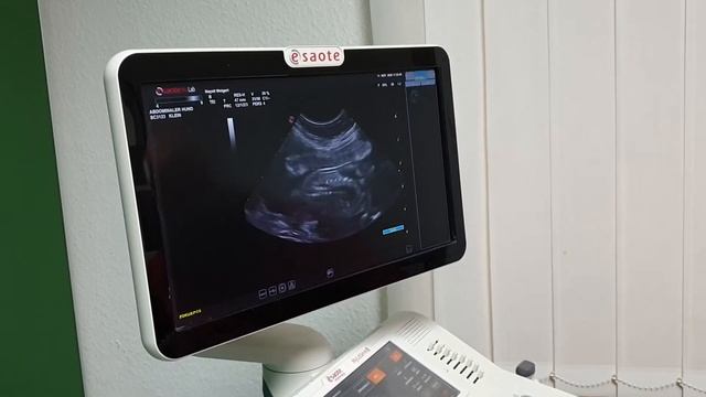 Ultraschall in der 6 Schwangerschaftswoche смотреть онлайн