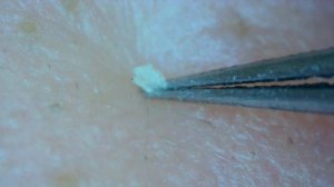 0223 keratin plug removal nose